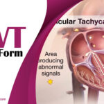 SVT Full Form: Understanding the Complete Form of Medical Term